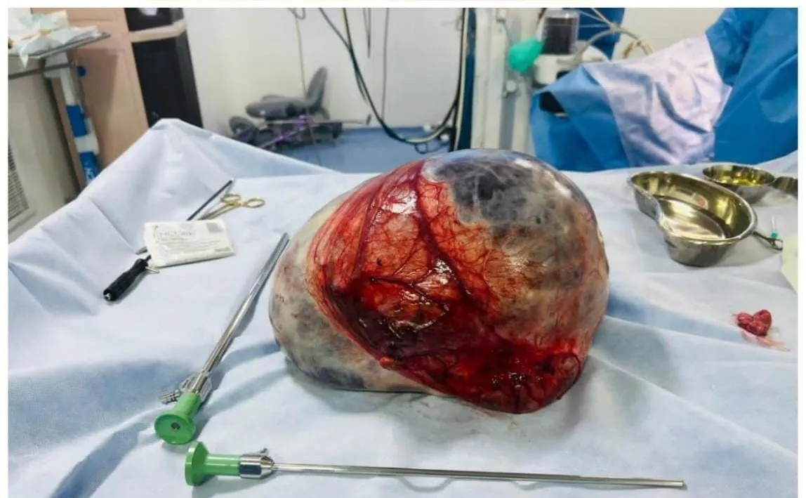 CARE Hospitals, Hitech City में 35 सेमी ओवेरियन ट्यूमर की सफल सर्जरी, 59 वर्षीय मरीज की हालत स्थिर